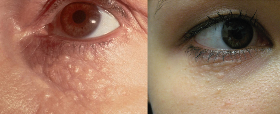 여드름 눈 밑 한관종 비립종 깨끗하게 없애는 법 아그네스 레이저 관련 이미지 5