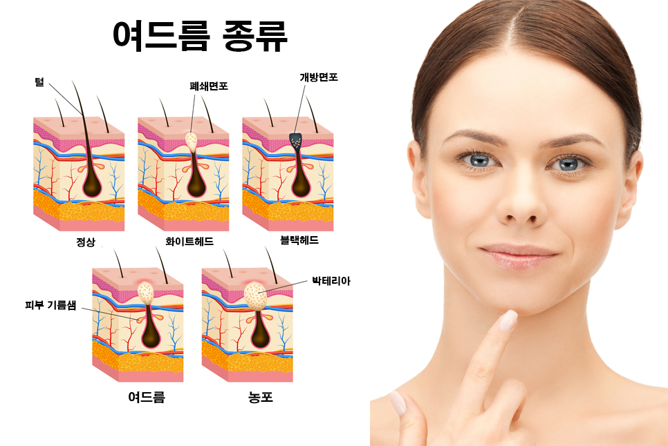 여드름에 직빵!! 여드름 자국 및 흉터 개선에 효과적인 스케일링 케어 관련 이미지 4