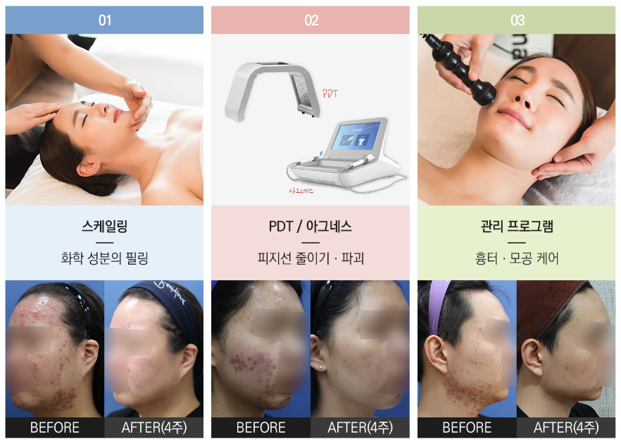 여드름에 직빵!! 여드름 자국 및 흉터 개선에 효과적인 스케일링 케어 관련 이미지 6