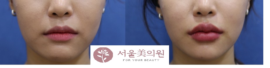 입술필러 트랜드의 변화 관련 이미지 1