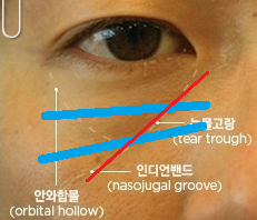 눈밑필러 잘하는 곳?? 관련 이미지 3