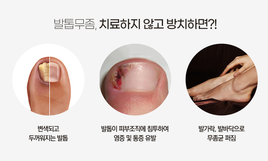 발톱무좀 신림역피부과 오니코레이저로 개선해요. 관련 이미지 2