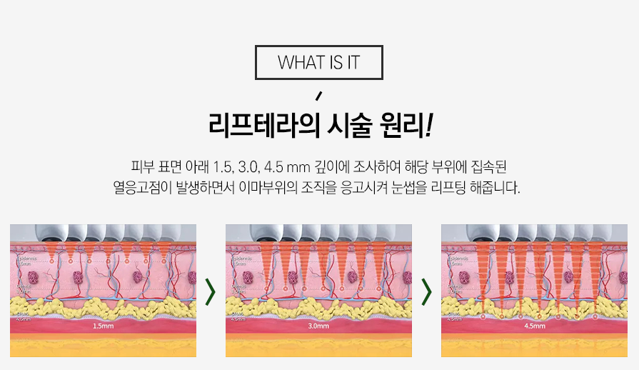 서울대입구역리프테라 노화로 고민된다면 관련 이미지 6
