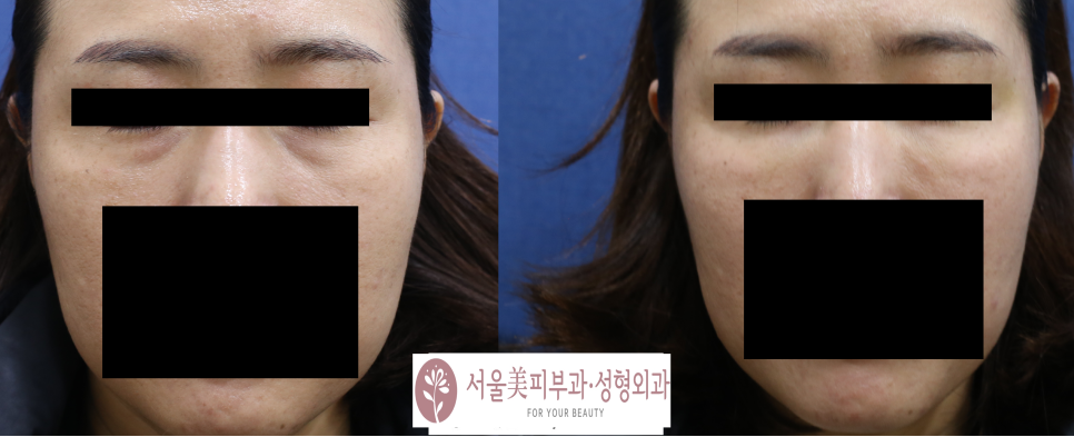눈밑필러 잘하는 곳?? 관련 이미지 1