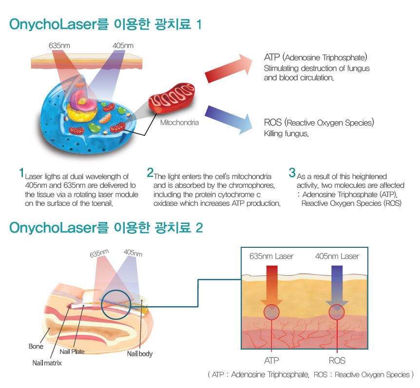 관악구 발톱무좀레이저-오니코레이저로 무좀안녕 관련 이미지 4