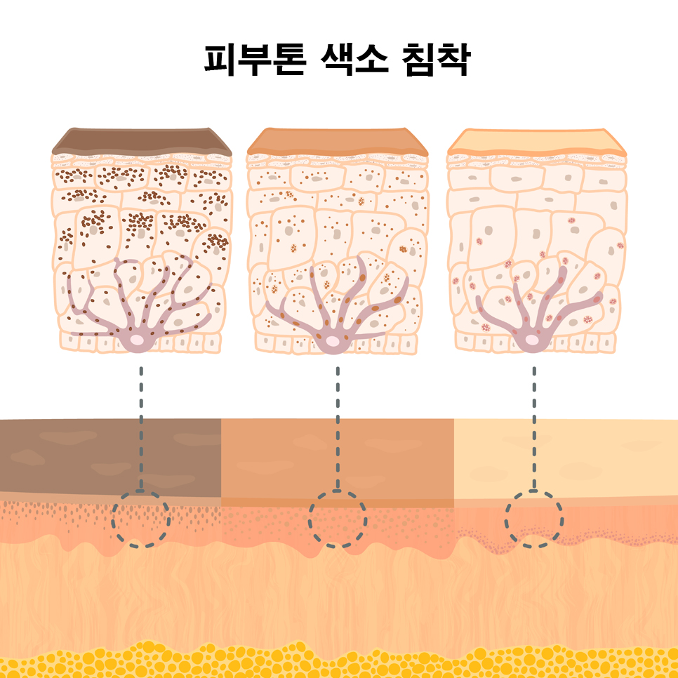 깨끗한 피부를 만드는 기미 잡티 주근깨 빠르게 없애는 법 꿀팁 서울대입구 피코토닝 관련 이미지 5