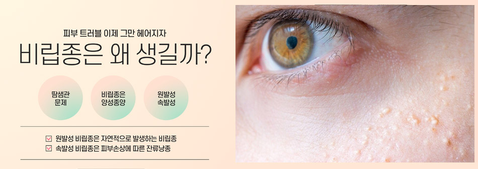 여드름 눈 밑 한관종 비립종 깨끗하게 없애는 법 아그네스 레이저 관련 이미지 7