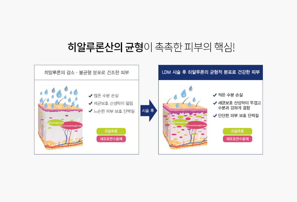 LDM 물방울리프팅으로 피부에 촉촉함을 선사하자 관련 이미지 5
