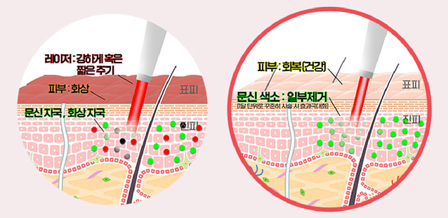 [서울대입구피부과] 깔끔하고 빠른 문신제거를 원한다면? 피코레이저! 관련 이미지 5