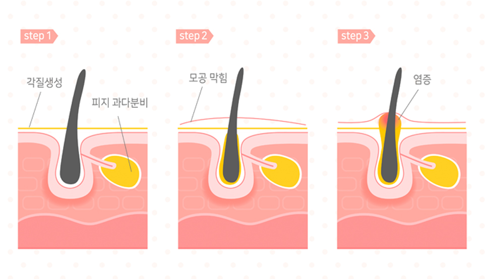 여드름에 직빵!! 여드름 자국 및 흉터 개선에 효과적인 스케일링 케어 관련 이미지 2