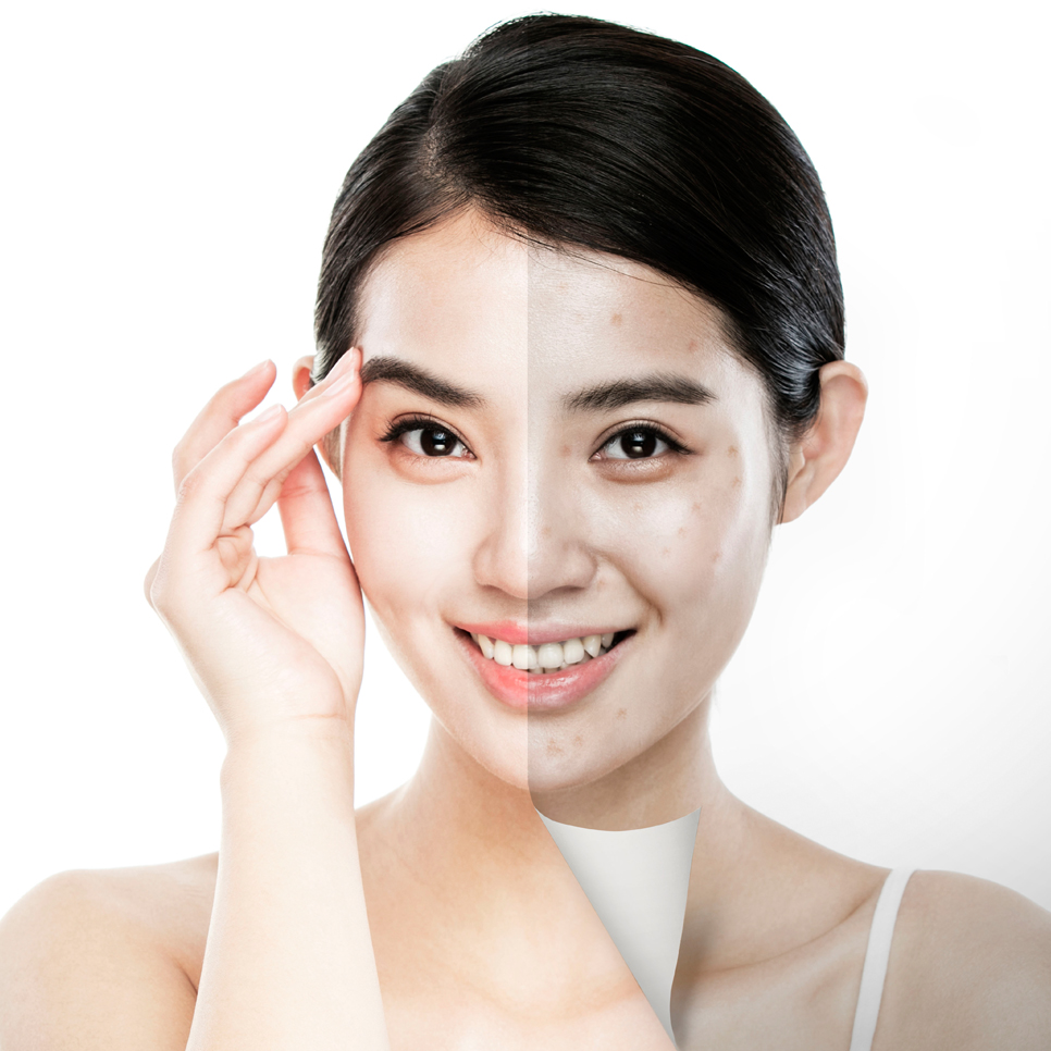 깨끗한 피부를 만드는 기미 잡티 주근깨 빠르게 없애는 법 꿀팁 서울대입구 피코토닝 관련 이미지 2