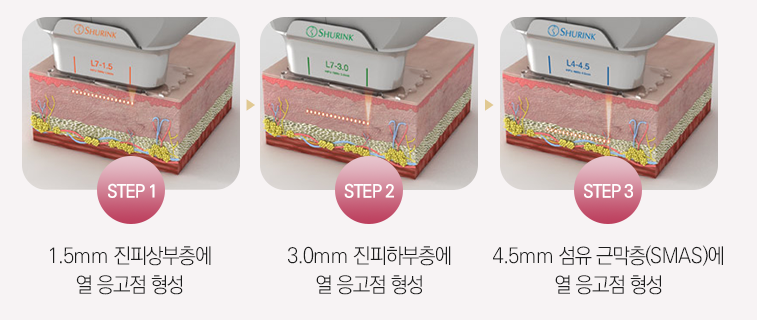 나이가 들수록 처지는 피부 탄력과 깊어지는 목주름 개선하는 슈링크 효과 관련 이미지 5