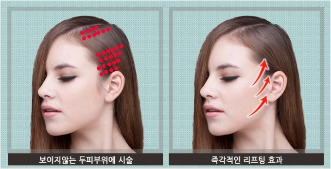 볼살 안빠지게 쉬링크 하는 법, 슈링크와 에어젯 관련 이미지 6