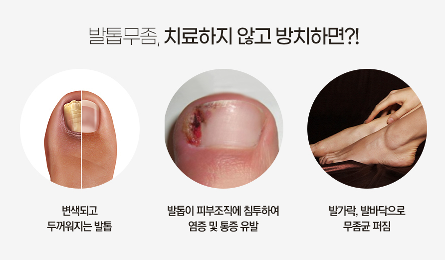 관악구피부과 발톱무좀 깔끔하게 제거 관련 이미지 4