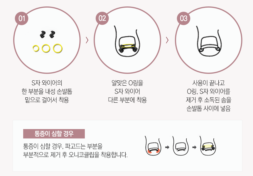 서울대입구피부과 믿고 맡기는 내성발톱치료 관련 이미지 5