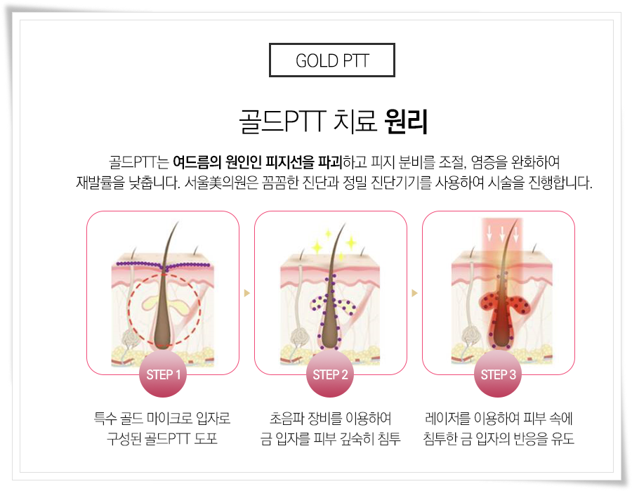 에토좀ptt 여드름 솔루션을 찾는다면 관련 이미지 5