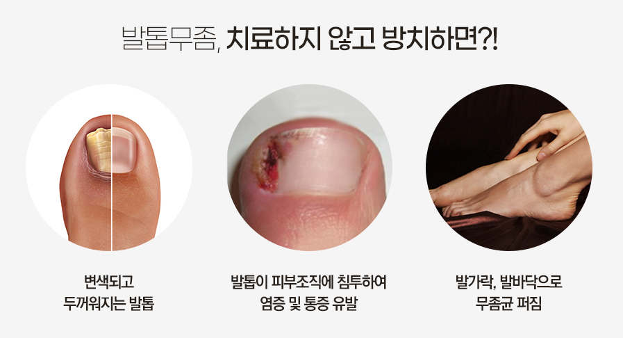 관악구발톱무좀레이저 만성화 이제 그만 관련 이미지 4