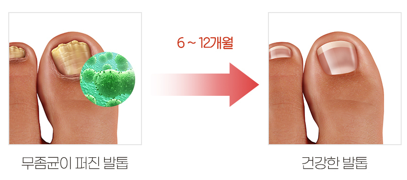 발톱무좀 신림역피부과 오니코레이저로 개선해요. 관련 이미지 4