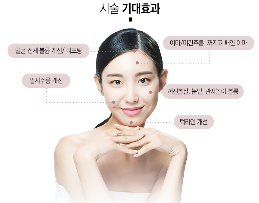 서울대입구스컬트라, 일반 필러와 뭐가 다를까? 관련 이미지 3