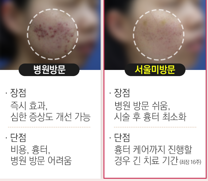 여드름 없애는법! 알아보고 케어하는 것이 중요 관련 이미지 3