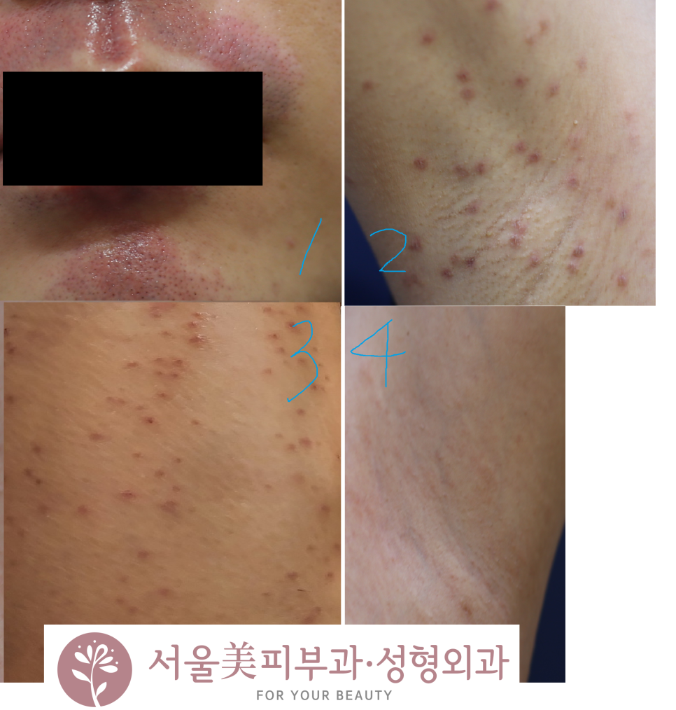 레이저 제모 후 모낭염이 생겼을 때 관련 이미지 1