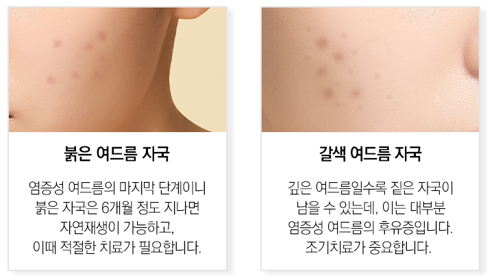 봉천동여드름 케어로 흉터까지 완벽한 피부 관련 이미지 4