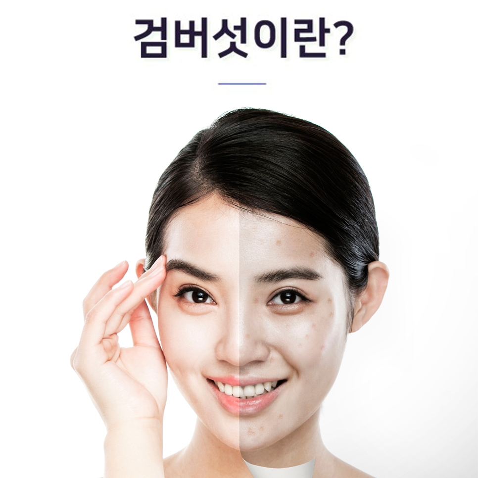 얼굴 손등 거뭇거뭇한 검버섯 부끄러운 분들 계신가요? 관련 이미지 2