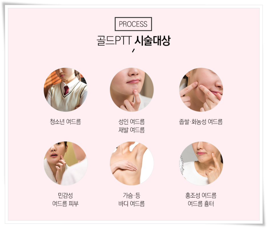 에토좀ptt 여드름 솔루션을 찾는다면 관련 이미지 7