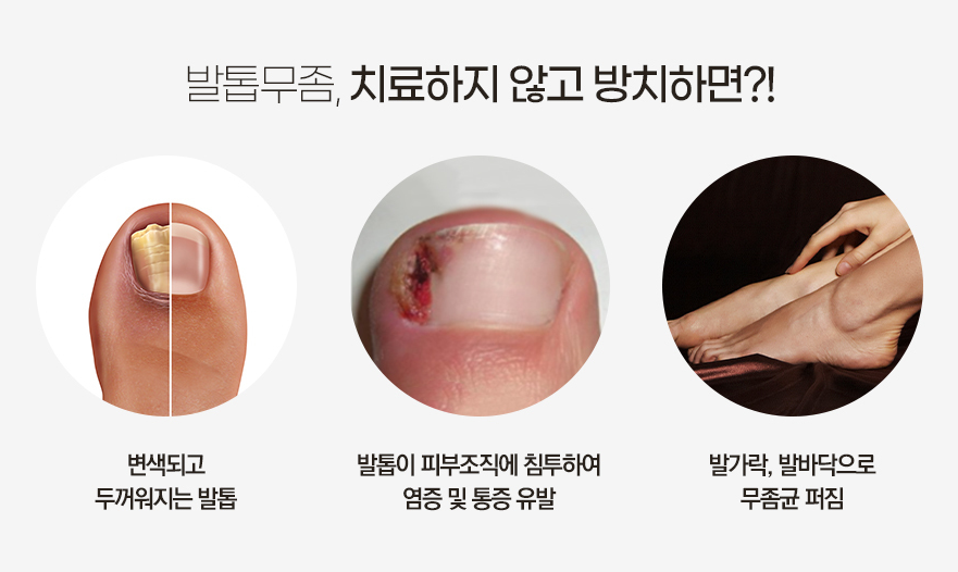무좀레이저 발 상태를 고려하면서 관련 이미지 4