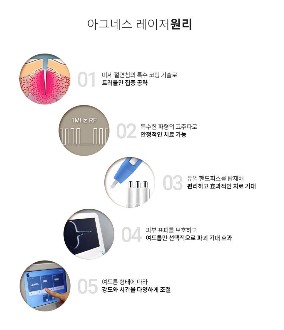 아그네스레이저 여드름치료 하세요 관련 이미지 6