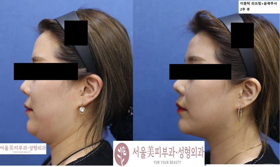 서울대입구역 실리프팅 얼마나 좋아질까? 관련 이미지 1