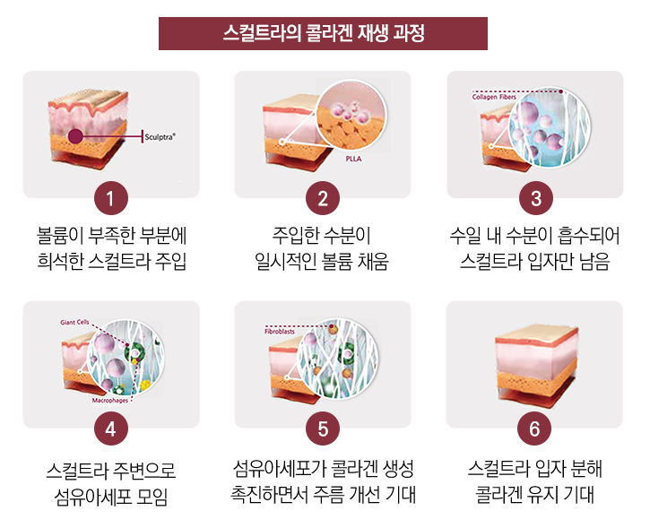 서울대입구스컬트라, 일반 필러와 뭐가 다를까? 관련 이미지 2