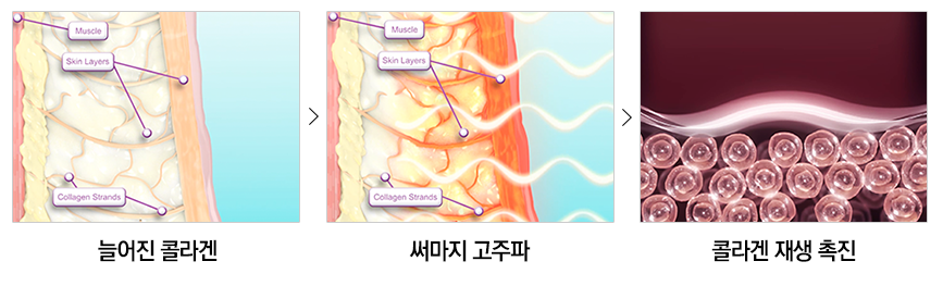 피부 속까지 강력하게 리프팅하자! 신림동써마지 관련 이미지 4