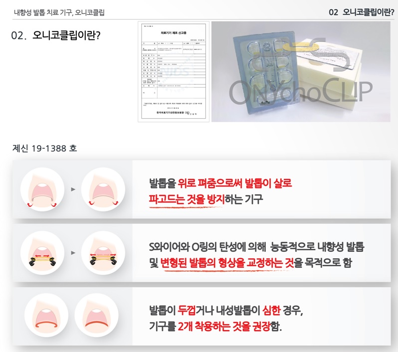 내향성손발톱 교정- 어렵지 않아요 관련 이미지 2
