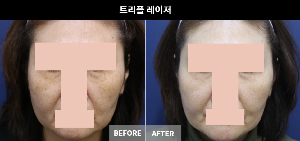 삼성역 색소치료, 여름 지나고 유독 진해진 기미가 신경 쓰인다면 관련 이미지 1