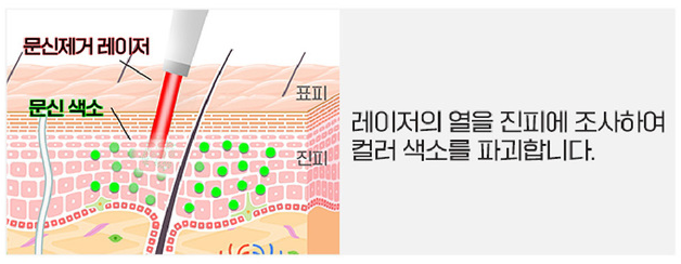 [서울대입구피부과] 깔끔하고 빠른 문신제거를 원한다면? 피코레이저! 관련 이미지 4