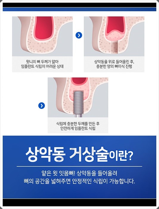 라임나무치과 오스템임플란트 비용이 궁금하셨다고요? 관련 이미지 8