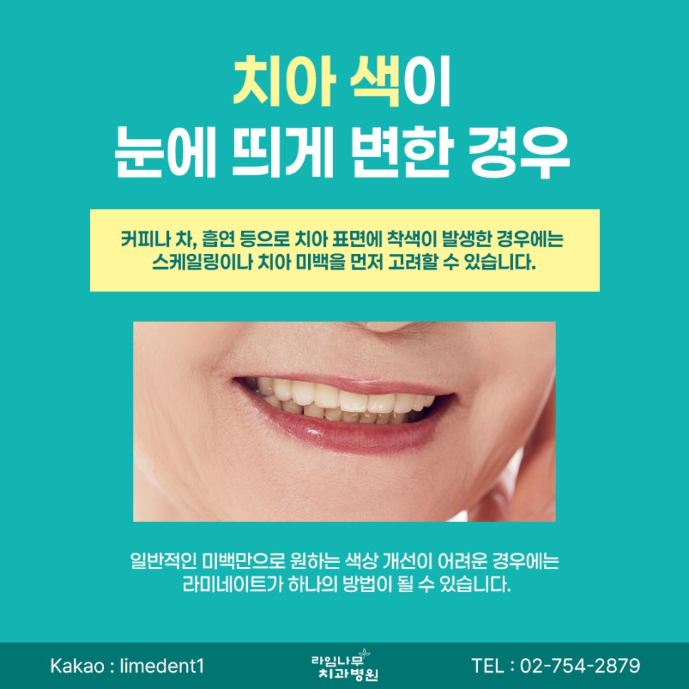 명동 라미네이트 앞니 모양이 고민이라면? 라미네이트로 개선할 수 있는 경우 관련 이미지 6