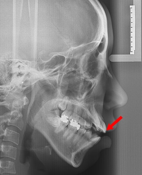 덧니의 정의와 덧니 교정방법 관련 이미지 9