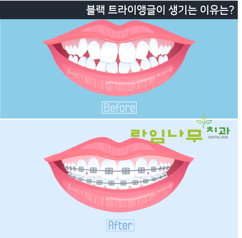 명동치과 잇몸 사이 틈? 치아 공간이 신경 쓰여요. 블랙트라이앵글/라임나무치과 관련 이미지 2