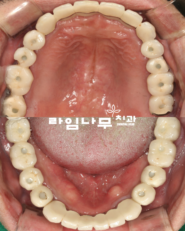 명동치과 전체임플란트 증례! 치주염으로 전체 치아의 기능을 상실한 치아 관련 이미지 6