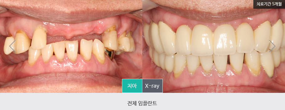 [명동치과] 하루 만에 전악 20개 임플란트 수술 가능! 라임나무치과 원데이 임플란트 관련 이미지 6