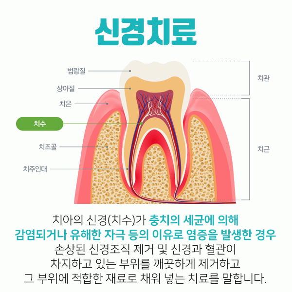 신경치료보다 더힘든 재신경치료, 치과선택은? 관련 이미지 1