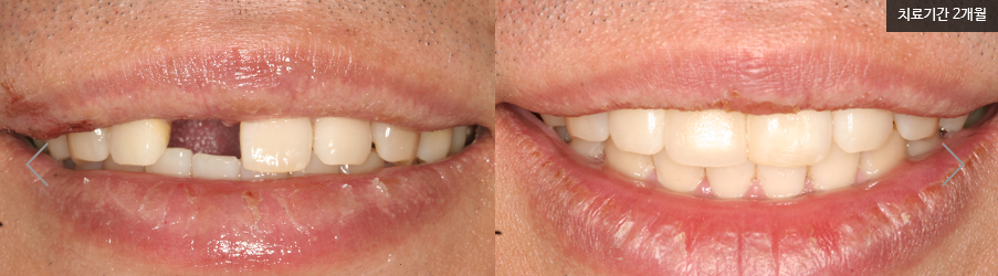 앞니 임플란트 후기 티나지 않아요 명동치과 라임나무 관련 이미지 7