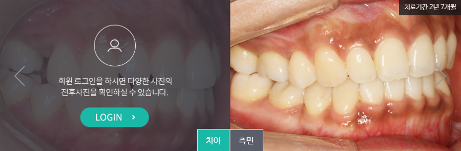 [명동 역삼 라임나무치과] 치아교정, 이런 분들께 꼭 필요해요! 관련 이미지 7