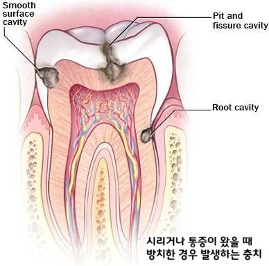 단음식을 먹을 때 치아가 시리다면? 충치 의심해 보세요. 관련 이미지 3
