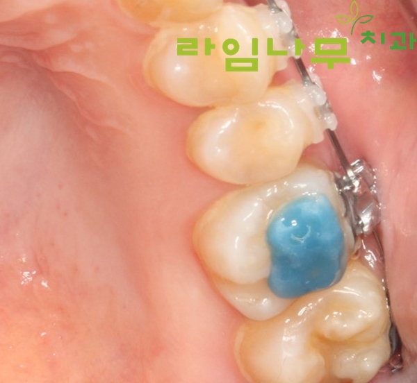 치아교정 중 어금니 파란색 레진? 제거시기 떨어졌을 때 알아봐요! 명동치과 관련 이미지 2