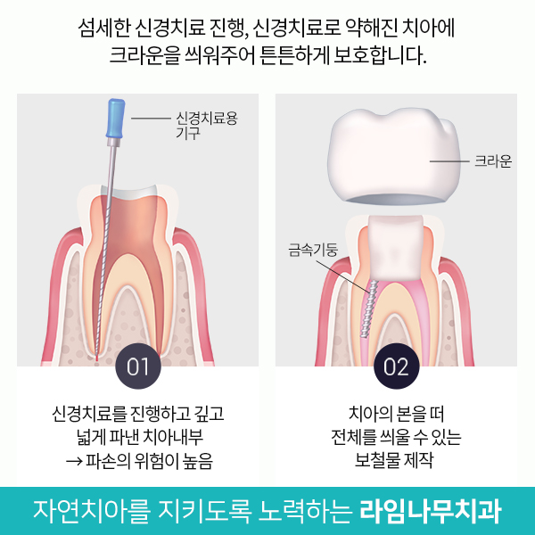 신경치료보다 더힘든 재신경치료, 치과선택은? 관련 이미지 4