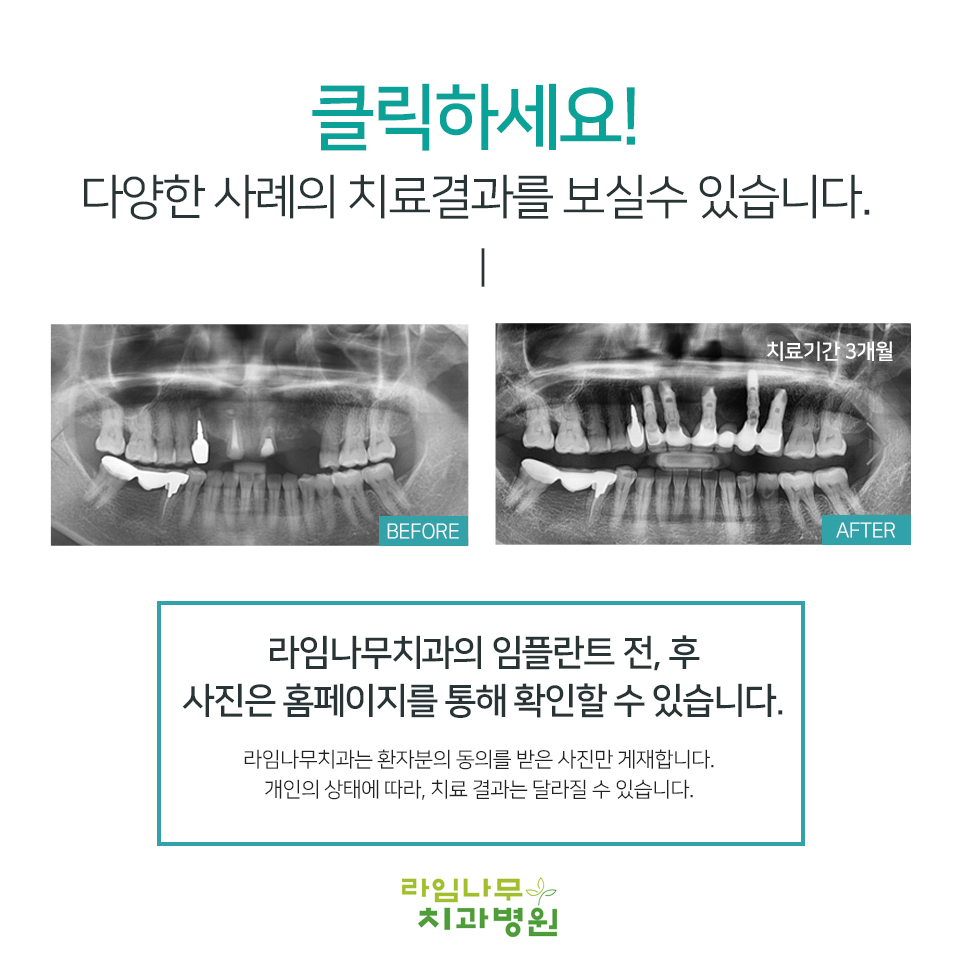 당일임플란트 20년 노하우가 남다르른 곳 관련 이미지 11