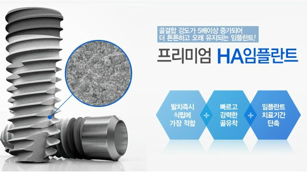 앞니임플란트 기간 얼마나 걸려요? 관련 이미지 2